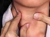 Киста щитовидной железы и народные средства