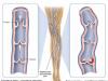 Тромбы в сосудах: артериях и венах – причины, лечение, локализации