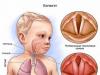 Kas geriau veikia sergant laringitu: Pulmicort vs Berodual Kas yra laringitas