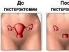 Consequences of hysterectomy for the body - reviews from women