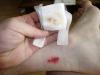 How to properly treat a wound at home How to treat a non-healing wound