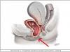 Opadnięcie i utrata wewnętrznych narządów płciowych (wypadanie narządów płciowych)