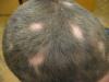 Baldness vīriešiem - pazīmes un simptomi Baldness pazīmes
