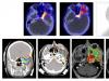 Kas ir labāks par smadzeņu CT vai MRI: kā tie atšķiras - Medsi Kāda ir atšķirība starp MRI un CT