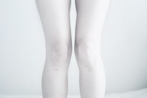 Клешнеобразная стопы новорожденных. Бледные ноги девушки. Кэти кэмпбелл анорексия. Стройные ноги. Бледные ножки девушки.