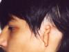 Vidinės ausies ir kochlearinės implantacijos anomalijos