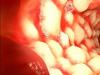 Sintomi della malattia di Crohn nei bambini e metodi di trattamento dell'infiammazione del tratto digestivo