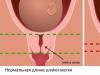 Istomico-cervicale insufficiëntie: kenmerken van zwangerschap en bevalling