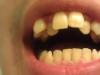 ફેંગ્સની સ્થિતિને સુધારવા માટેની પદ્ધતિઓ દાંતને સીધા કરવા