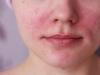 Allergie gegen Frost im Gesicht